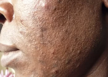 The damage bleaching can cause to the body