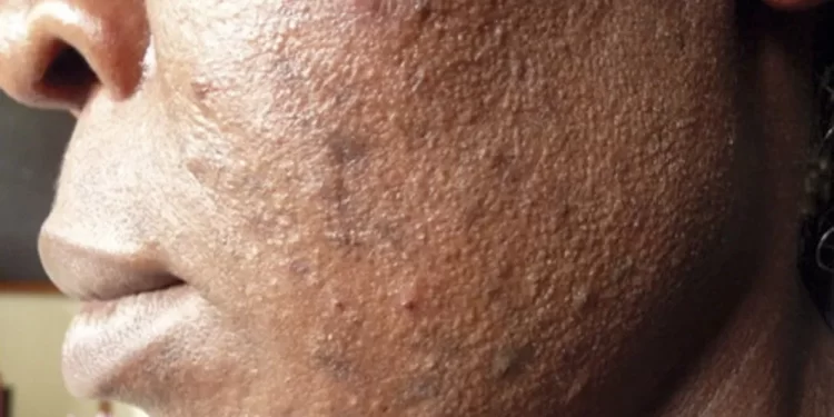 The damage bleaching can cause to the body