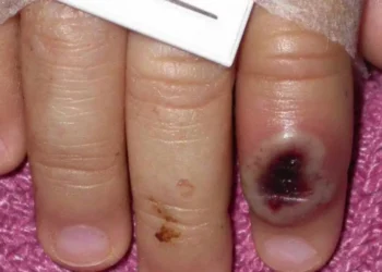 Europe, US on alert after new monkeypox cases emerge