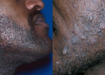 Natural home remedies that cure razor bumps and actually work