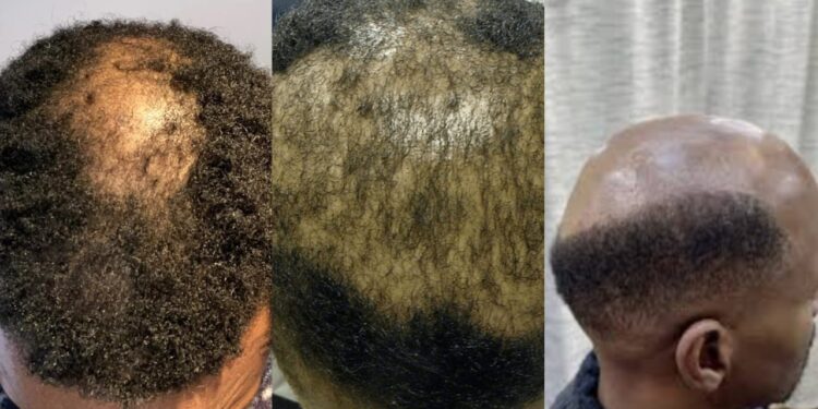 Dealing with hair loss; natural remedies that heal and improve growth