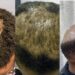 Dealing with hair loss; natural remedies that heal and improve growth
