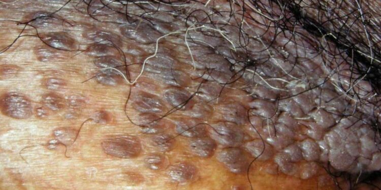 Genital Warts: What you should know; how to prevent and treat